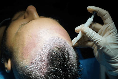 DHI Hair Transplantation