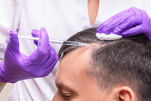 PRP Therapy for Hair