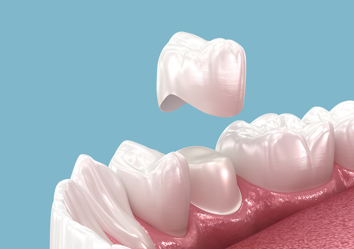 Luxury Dental Crowns