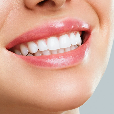 Full Smile Makeovers